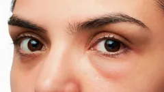 Jak odstranit ranní otok obličeje a proč k němu dochází – stylista odpovídá